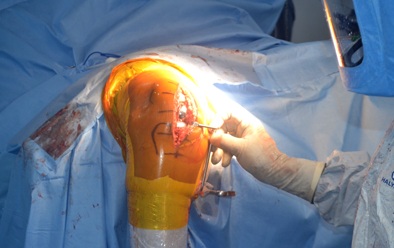 Partial Knee Replacement