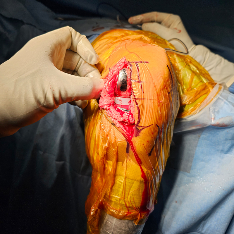 Total Knee Bone Removed
