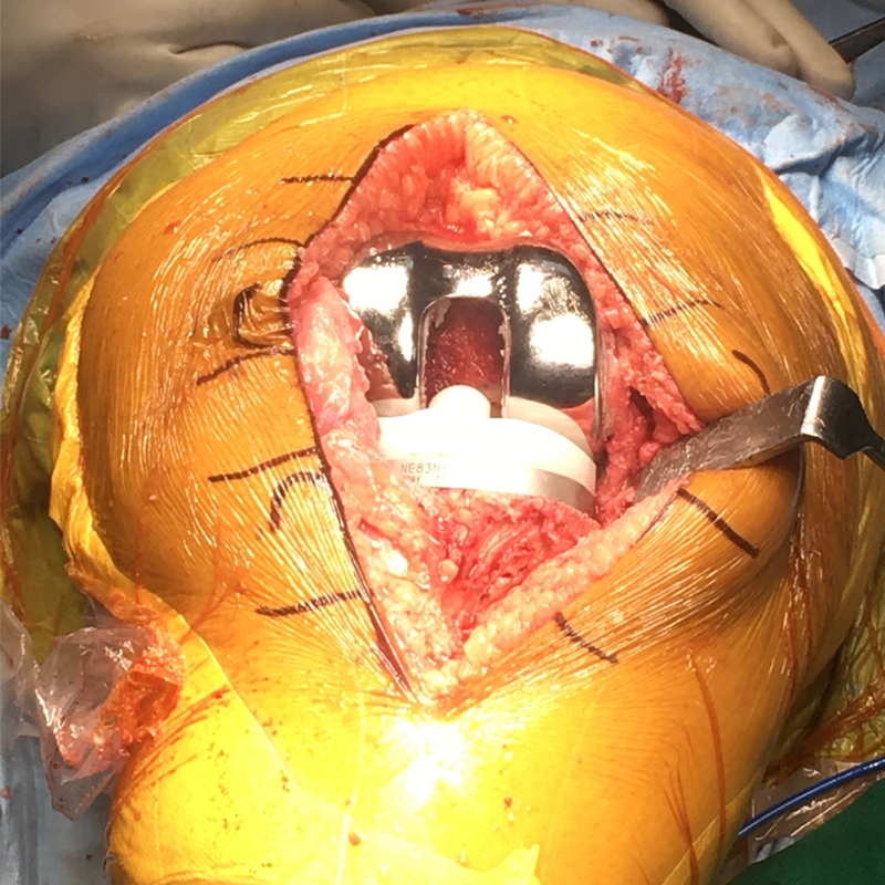 Total Knee Bone Removed