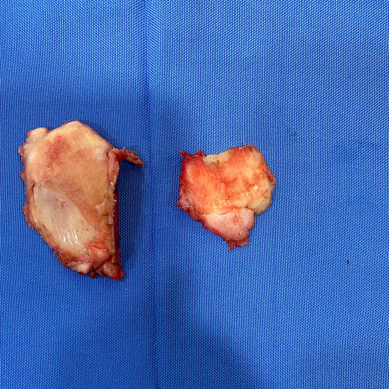 Partial Knee Bone Removed