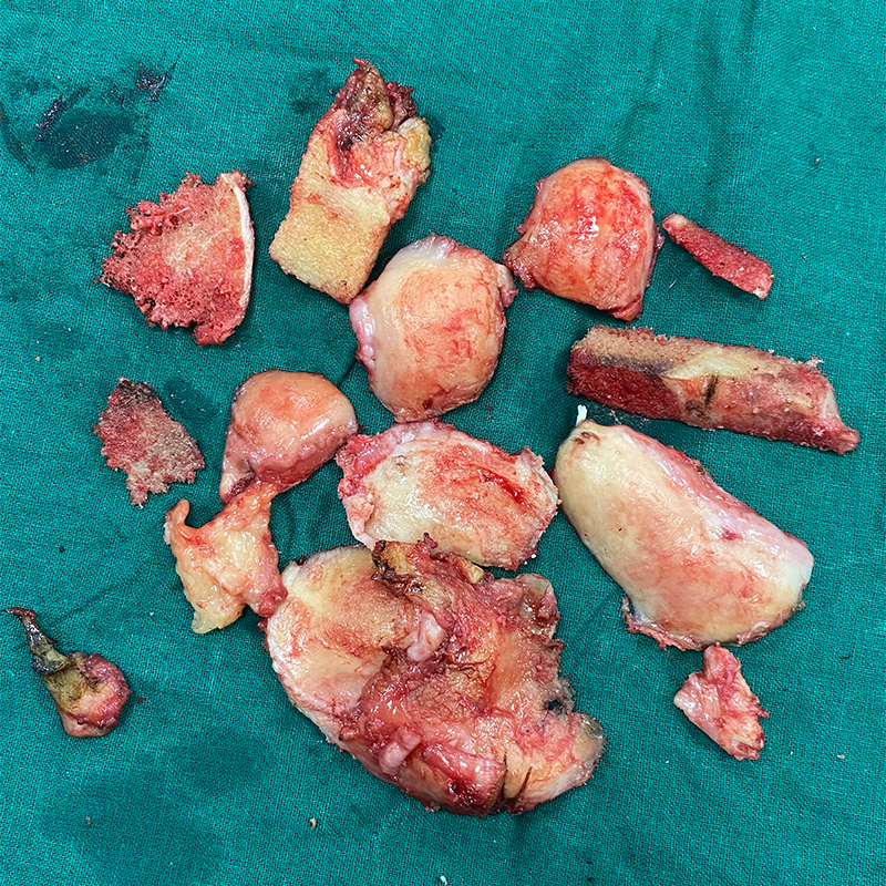 Total Knee Bone Removed